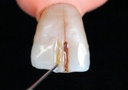 Resina Flow  - Foto Tetric N - Flow Bulk Fill  2g - Ivoclear Vivadent