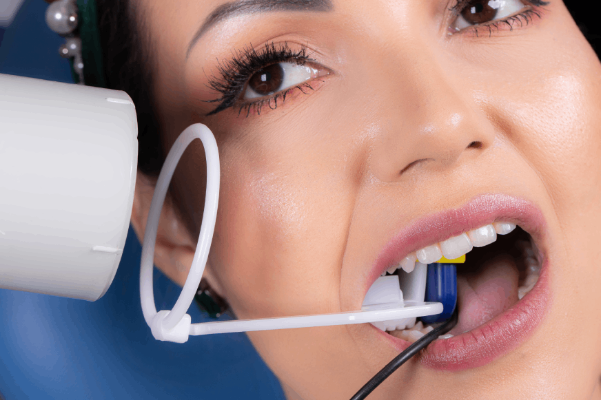 Posicionador para  radiovisógrafos  RVG  Cone Indicator Digital- Indusbello