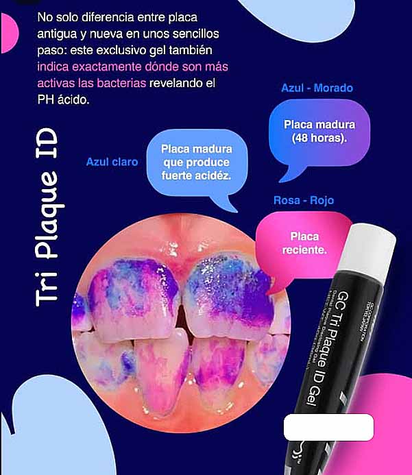Detector De Caries Sable Seek - Ultradent