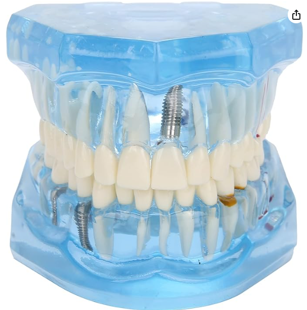  Modelo bucal de Implante para demostraciones - Generico